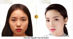 Quá trình gọt cằm diễn ra như thế nào