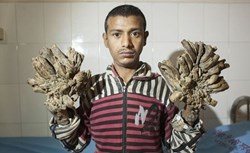 Người cây Bangladesh tái nhập viện vì bệnh nặng hơn